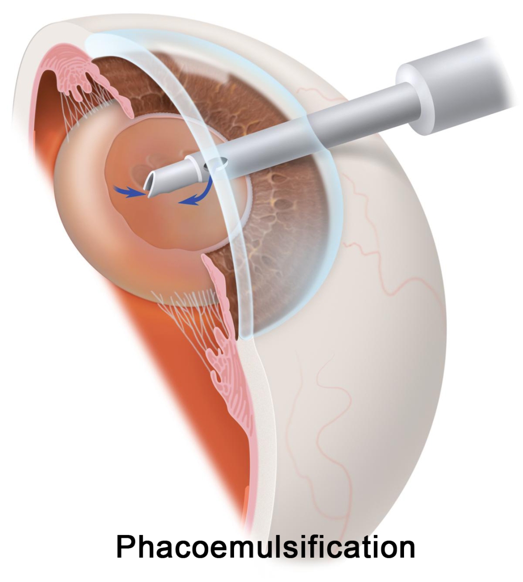 Операция факоэмульсификация катаракты. Катаракта факоэмульсификация. Факоэмульсификация катаракты с имплантацией ИОЛ. Катаракта имплантация ИОЛ. Лазерная экстракция катаракты.
